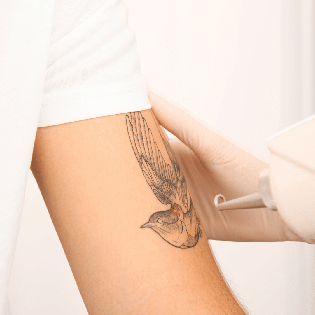 Détatouage au laser PicoSure Pro à la clinique médico-esthétique Unica MD à Montréal