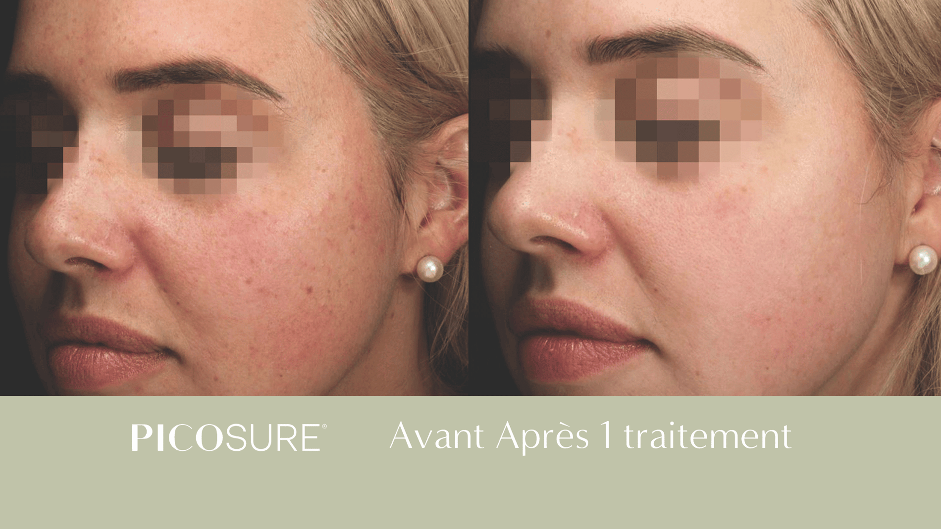 Photorejuvenation : before and after results at Unica MD