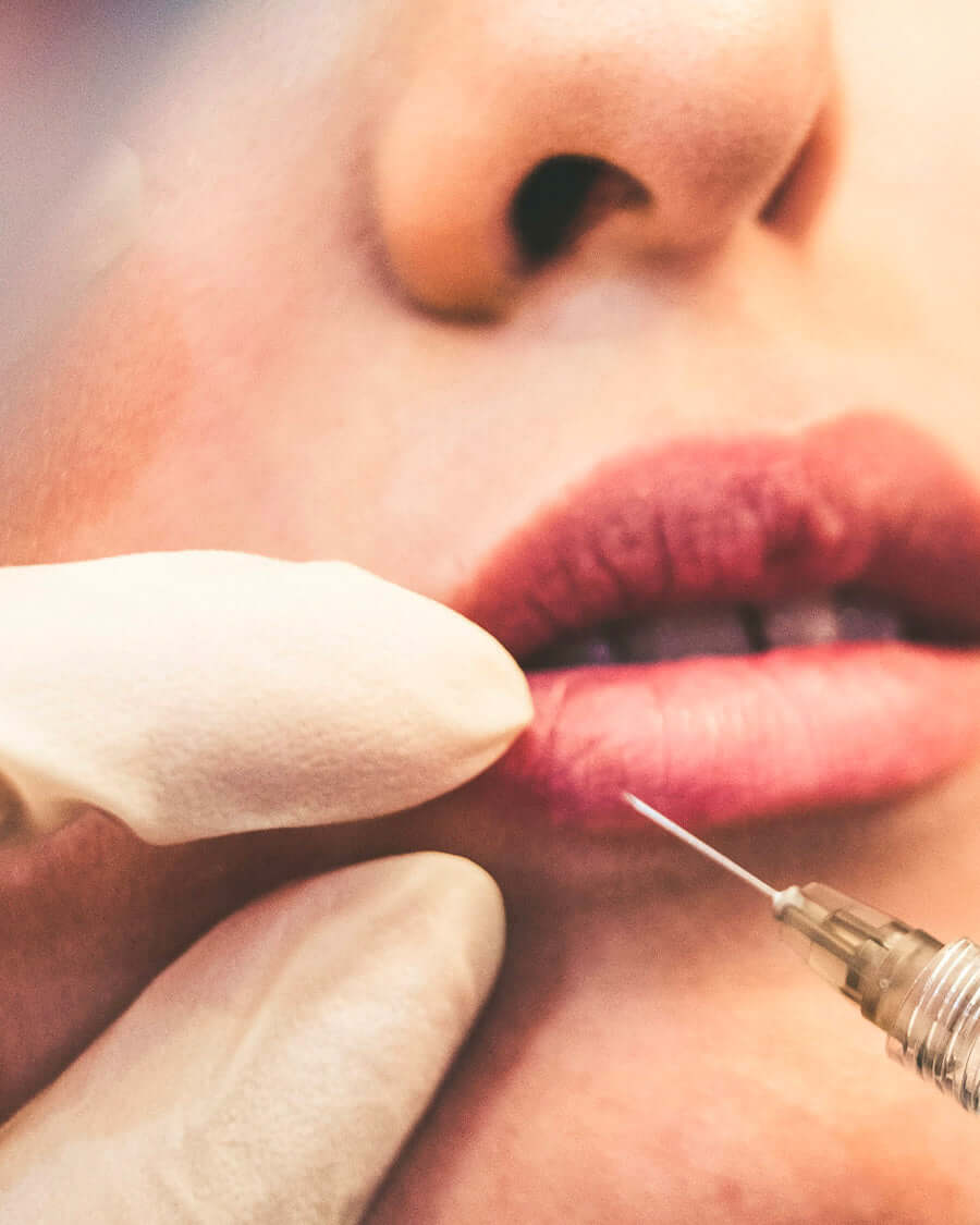 Lip Filler treatment at Clinic Unica MD in Montreal