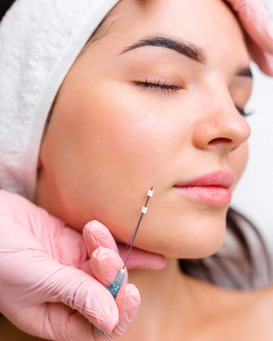 Aptos Thread Lifts treatment at Clinic Unica MD in Montreal