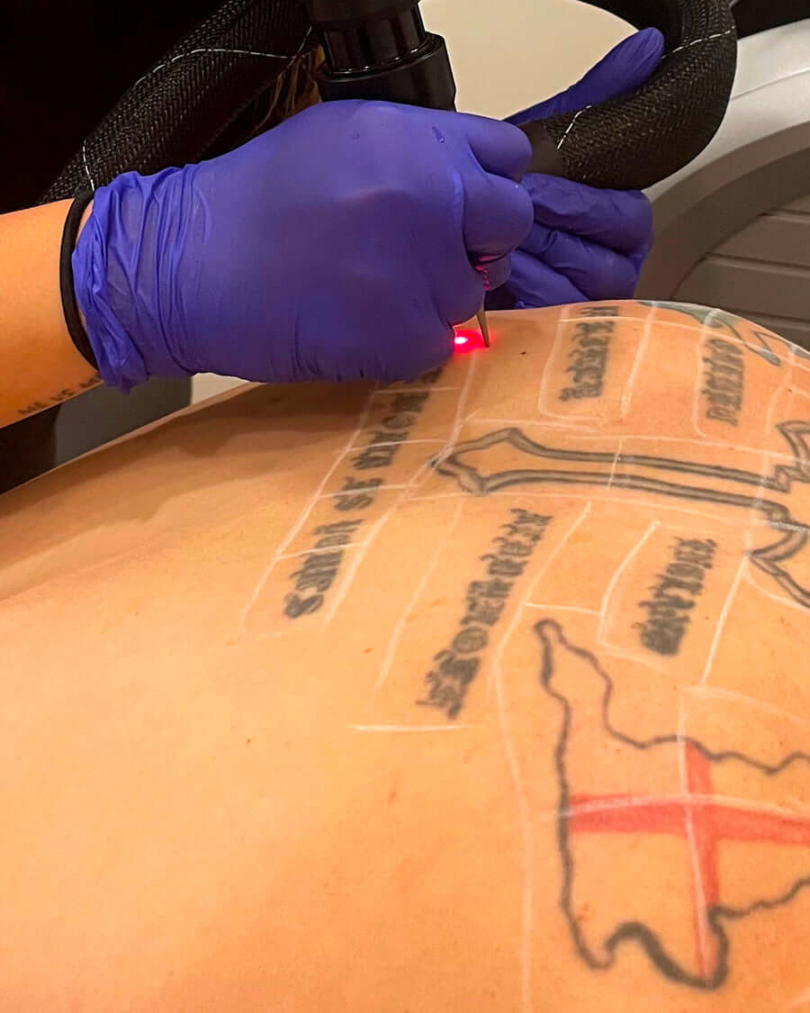 Effective tattoo removal in Montreal